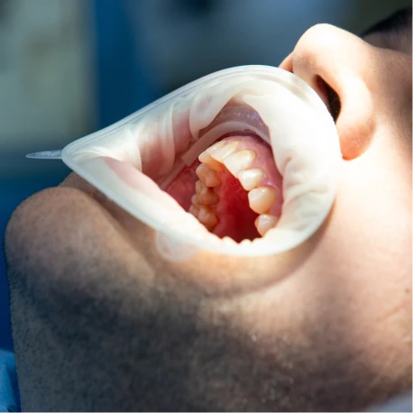 Tratamiento periodontal