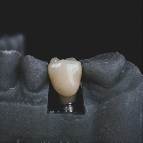 Implantes dentales
